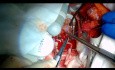 Refaire une chirurgie de pontage coronarien hors pompe via une thoracotomie gauche