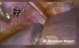 Sillons Accessoires sur la Surface Diaphragmatique du Foie
