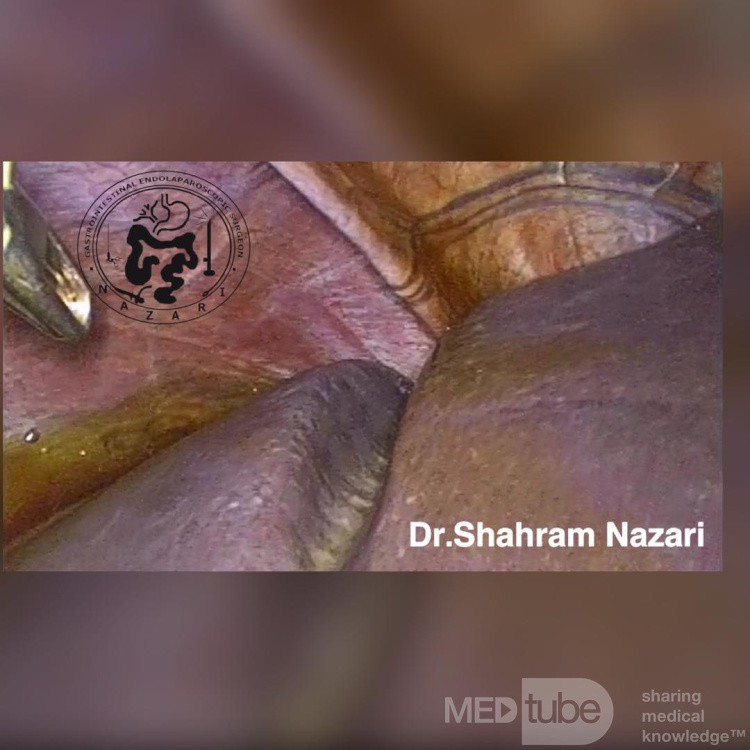 Sillons Accessoires sur la Surface Diaphragmatique du Foie