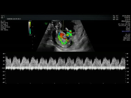 Doppler du Ductus Venosus (Conduit Veineux)