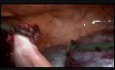Gros kystes pelviens - mini-laparoscopie