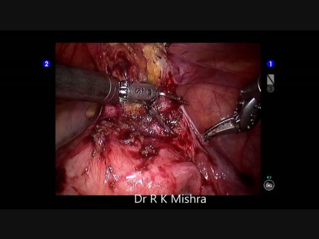 Adhésiolyse laparoscopique assistée par robot da Vinci