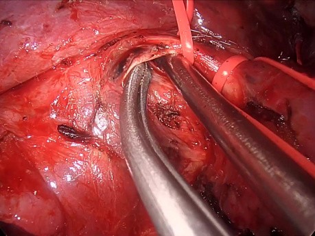 Retrait Vidéo-assisté Uniportal d'un Os de Poulet Intrabronchique avec Reconstruction Bronchique