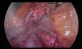 Artère hépatique remplacée par l'artère mésentérique supérieure (type 5) pendant la pancréatoduodénectomie par laparoscopie