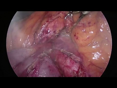Artère hépatique remplacée par l'artère mésentérique supérieure (type 5) pendant la pancréatoduodénectomie par laparoscopie