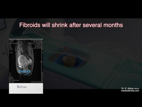 Ultrasons focalisés à haute énergie (HIFU) dans le traitement des fibromes utérins
