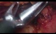 Pancréatectomie distale laparoscopique pour tumeur solide pseudopapillaire de grande taille - Procédure sur toute la longueur 