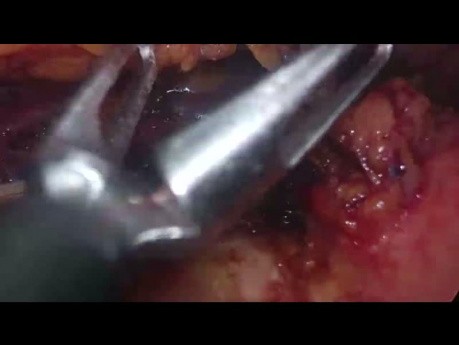 Pancréatectomie distale laparoscopique pour tumeur solide pseudopapillaire de grande taille - Procédure sur toute la longueur 