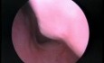 Les Végétation Adénoïdes - Vue Endoscopique