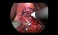 Myotomie de Heller coelioscopique et Fundoplication de DOR pour Traitement de l'Achalasie