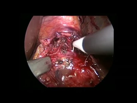 Myotomie de Heller coelioscopique et Fundoplication de DOR pour Traitement de l'Achalasie