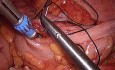 Sigmoïdectomie avec l'extraction d'échantillon par un orifice naturel