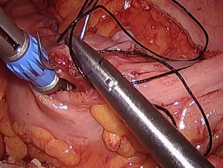 Sigmoïdectomie avec l'extraction d'échantillon par un orifice naturel