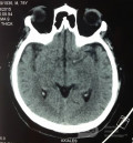Hyperdensité de l'artère cérébrale moyenne 