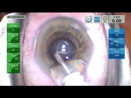  Chirurgie de la Cataracte sur Oeil de 19mm