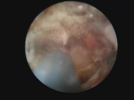 Traitement endoscopique du sinus pilonidal