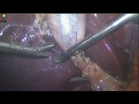 Contrôle du Canal Cystique avec Ablation de Sutures