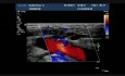 Régurgitation de la valve de veine saphene (une incontinence valvulaire autorisant un reflux sanguin)