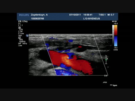 Régurgitation de la valve de veine saphene (une incontinence valvulaire autorisant un reflux sanguin)