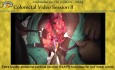 Technique d'Excision Abdomino-Périnéale Extra-Elévatrice (Elape) pour le Cancer du Bas Rectum