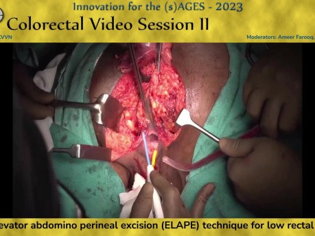 Technique d'Excision Abdomino-Périnéale Extra-Elévatrice (Elape) pour le Cancer du Bas Rectum