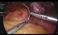 Mini Bypass Gastrique + Fundoplication Nissen + Réparation de Hernie Hiatale