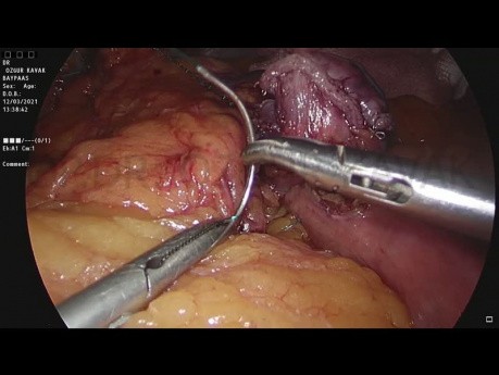 Mini Bypass Gastrique + Fundoplication Nissen + Réparation de Hernie Hiatale