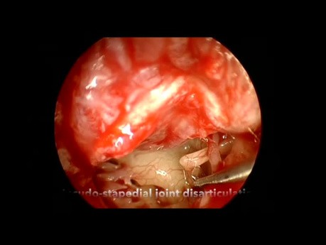Stapédotomie Endoscopique pour Otospongiose (Microforet)