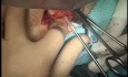 Fracture Complexe de l'Humérus Distal chez un Patient Pédiatrique