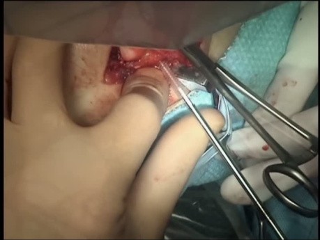 Fracture Complexe de l'Humérus Distal chez un Patient Pédiatrique