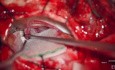 Décompression Microvasculaire pour le Spasme Hémifacial