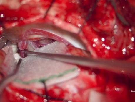 Décompression Microvasculaire pour le Spasme Hémifacial