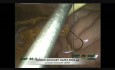 Jéjunostomie d'alimentation par laparoscopie