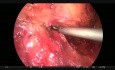 Résection antérieure par laparoscopie avec hernioplastie
