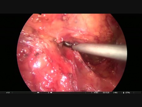Résection antérieure par laparoscopie avec hernioplastie