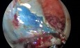 Dissection Sous-Muqueuse Transanale avec OET dans un Adénome Rectal Volumineux. Alternative Sûre à la DES.