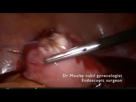 Myomectomie Laparoscopique Difficile