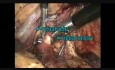 Néphrectomie gauche par laparoscopie