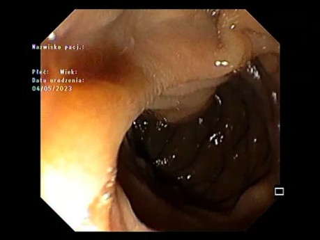 Aspect en Oeil de Poisson de l'Ampoule de Vater