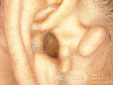Auricule accessoire