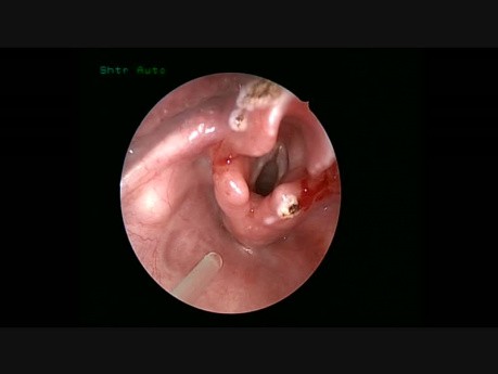 Chirurgie du larynx de l'enfant.