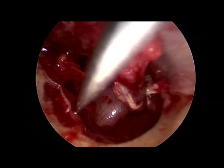Tympanoplastie Endoscopique de Type 3 pour Otite Moyenne chronique Séromuqueuse en Phase Active