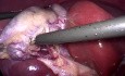 Bloodless Laparoscopic Cholecystectomy