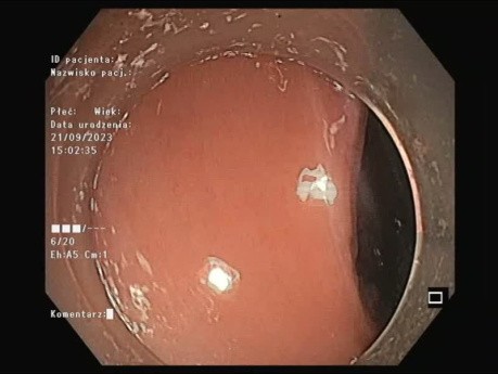 Résection de Tumeur à Extension Latérale (LST-G) par Dissection Sous-Muqueuse Hybride