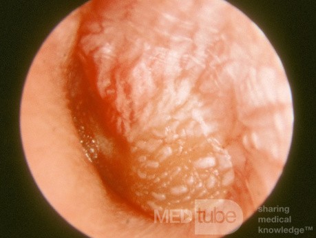 Otite aiguë sévère d'oreille gauche