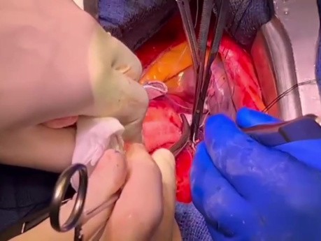PEARS ou Chirurgie Personnalisée de Soutien Externe de la Racine Aortique