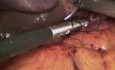 Traitement synchrone de l'obésité morbide et de la hernie hiatale par voie laparoscopique 