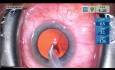 Chirurgie de la cataracte avec Microstent du Glaucome - Édition éducationnelle non éditée