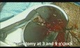 Résection de la sténose anale par voie transanale à l'aide d'une agrafeuse (STARR)