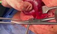 Le Trajet du Nerf Récurrent au Sein de la Thyroïde